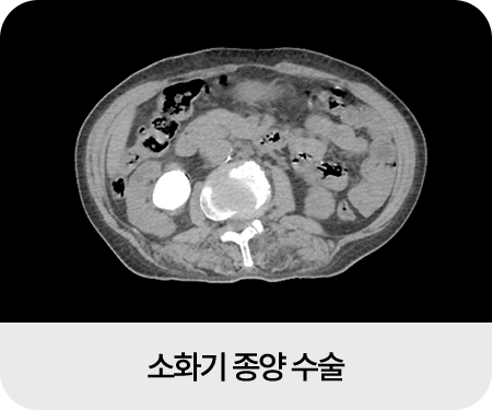 종양외과 수술 이미지01